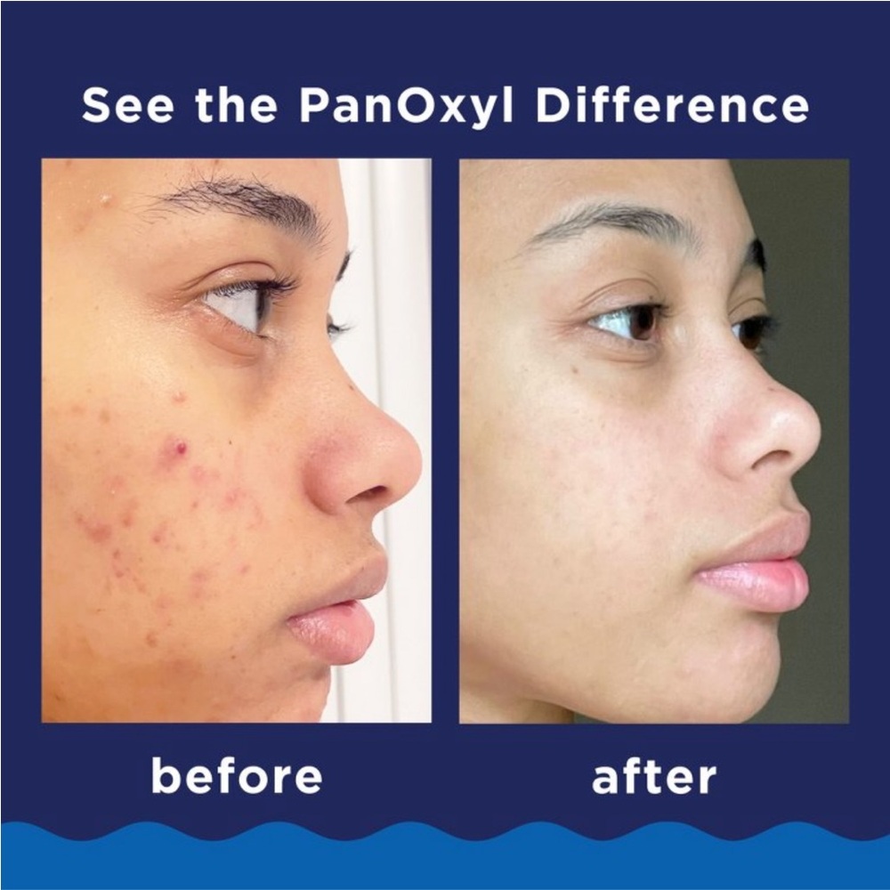 NWT PanOxyl Acne Foaming Wash Mini 1 oz/28 g